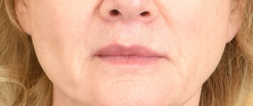 Lip Lift Patient 12 Set 1 After